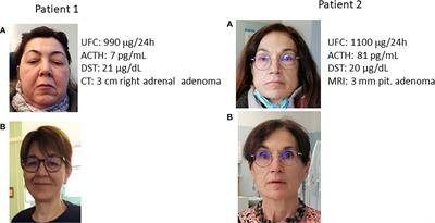 Grand Challenge in Adrenal Endocrinology: Is the Legacy of the Past a Challenge for the Future of Precision Medicine?